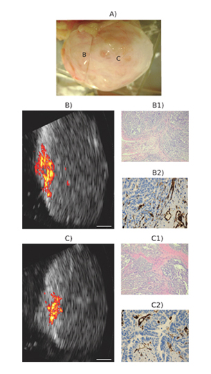 Imaging of a malignant postmenopausal ovary
