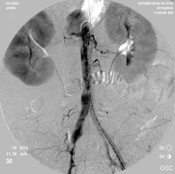 Angiogram taken at time of procedure