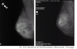 Traditional X-ray mammogram image (left) and digital mammogram image (right) of the same breast.